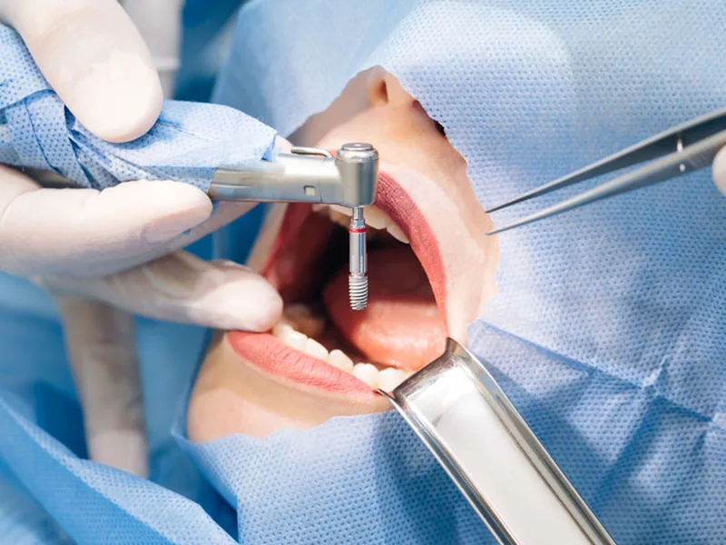 Inserimento di un impianto dentale in sala operatoria
