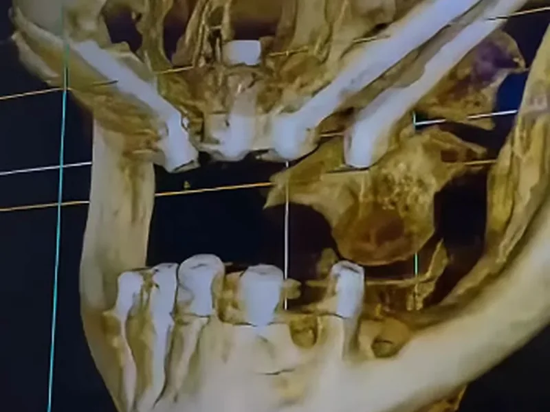 Ricostruzione 3D CBCT con impianti zigomatici