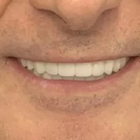 Sorriso dopo la riabilitazione completa su impianti
