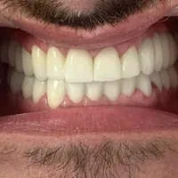 Sorriso dopo le corone complete in zirconia