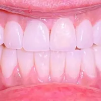 Sorriso dopo la riabilitazione estetica completa