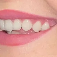 Sorriso dopo le corone estetiche