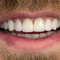 Sorriso dopo le faccette in porcellana