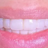 Sorriso dopo la trasformazione del sorriso